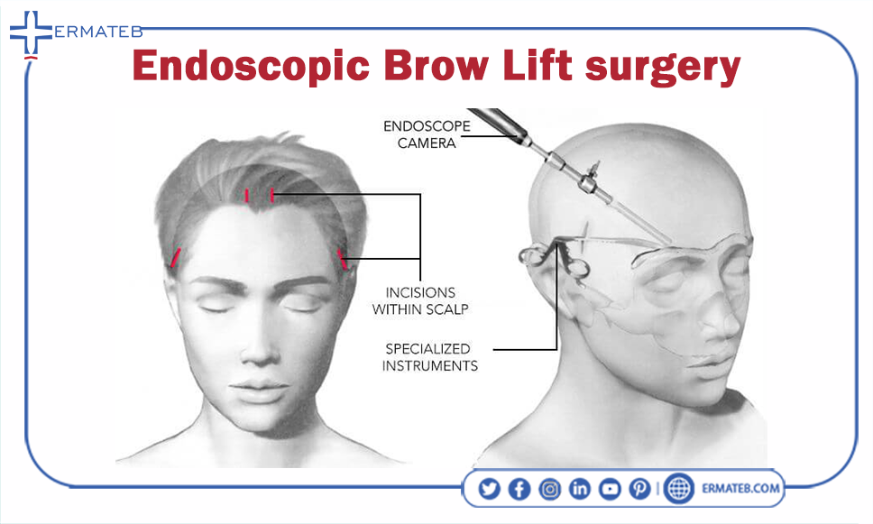 endoscopic Brow Lift surgery